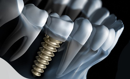 dental-implants-glasgow