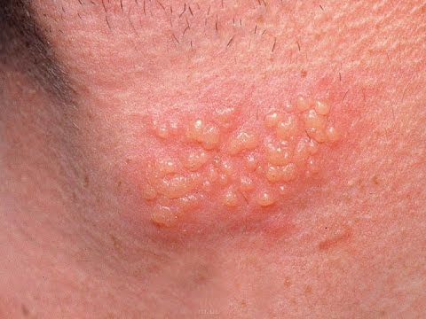 Herpes Skin Symptoms